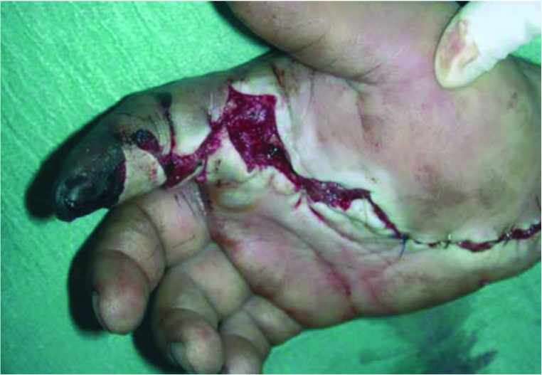 Hands are particularly vulnerable to fluid injection injuries, which can often require surgery