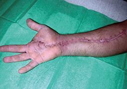 Although not very common, fluid injection injuries can be highly unpleasant